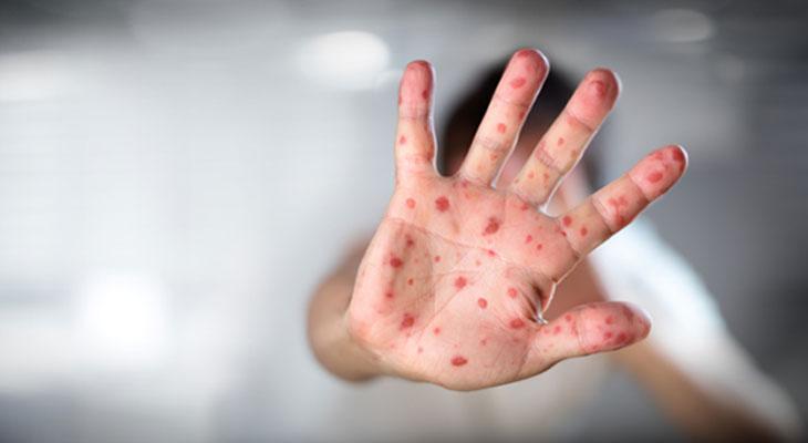 Nueva York en emergencia: antivacunas generan la peor epidemia de sarampión en 30 años-0